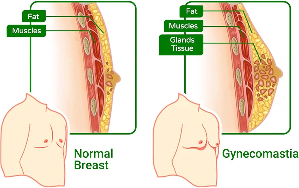 gynecomastia-compress-patch---ginger-cre-3.jpg